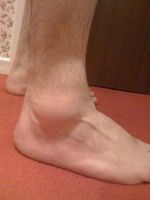 tratamento para tornozelo inchado